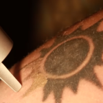 tattoo removal