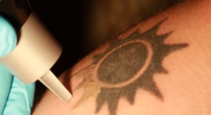 tattoo removal